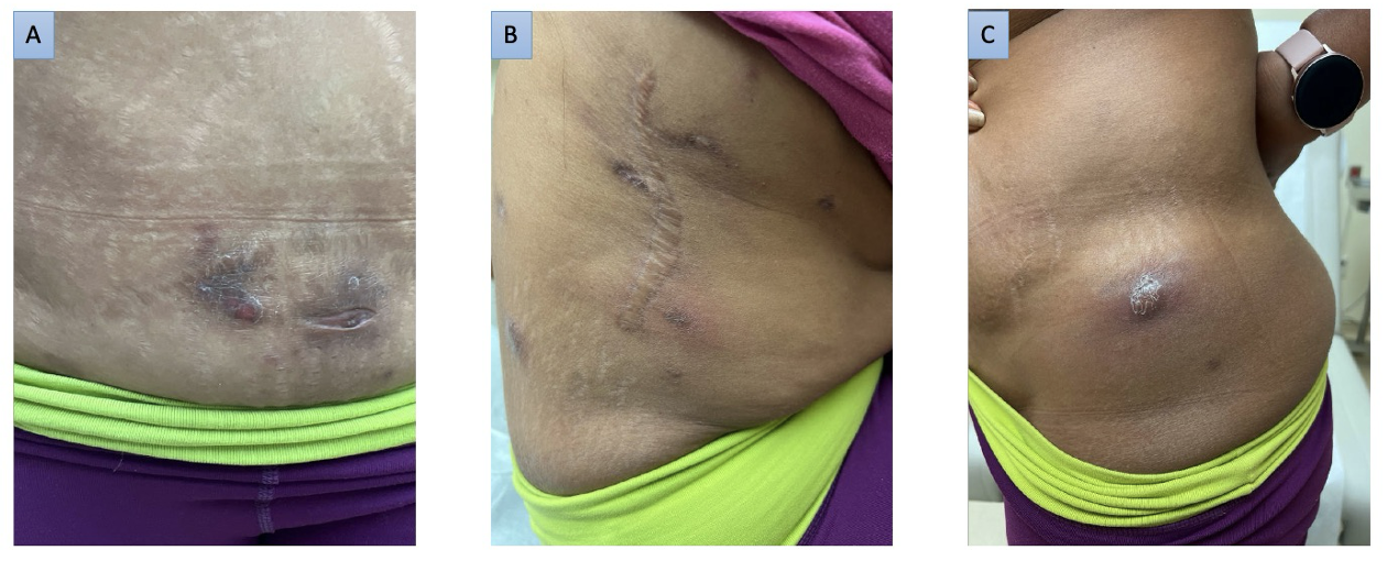 Medical Tourism in Plastic Surgery: A Case Series of Complications